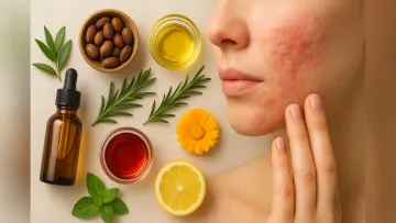 تاثیر روغن های طبیعی بر درمان درماتیت سبورئیک (درماتیت سبوره)