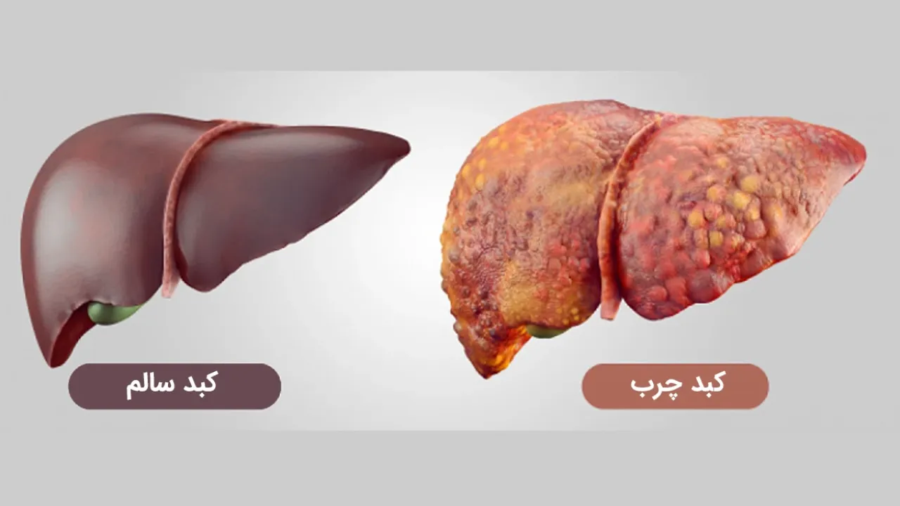 6 روش تشخیص بیماری کبد چرب از روی چهره