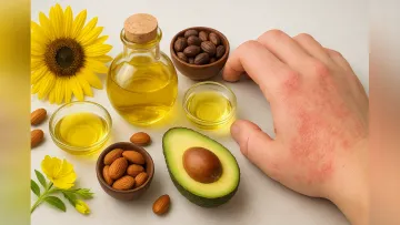 تاثیر روغن های طبیعی در درمان درماتیت آتوپیک